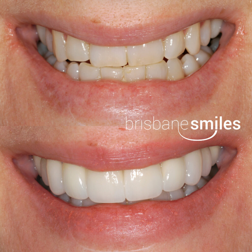 Porcelain Veneers Brisbane Cosmetic Dentist Brisbane Smiles