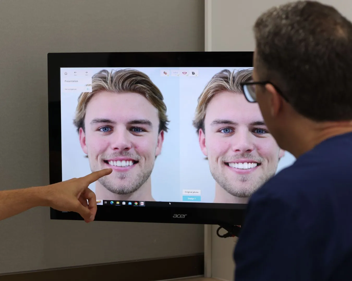 porcelain veneers dveneers brisbane smiles
