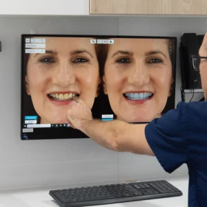 before and after digital smile simulation of a mature aged woman for smile makeovers