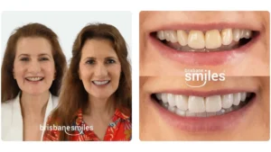 veneers before and after brisbane smiles