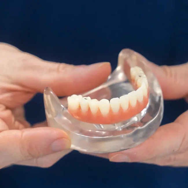 all on 4 dental implants teethxpress