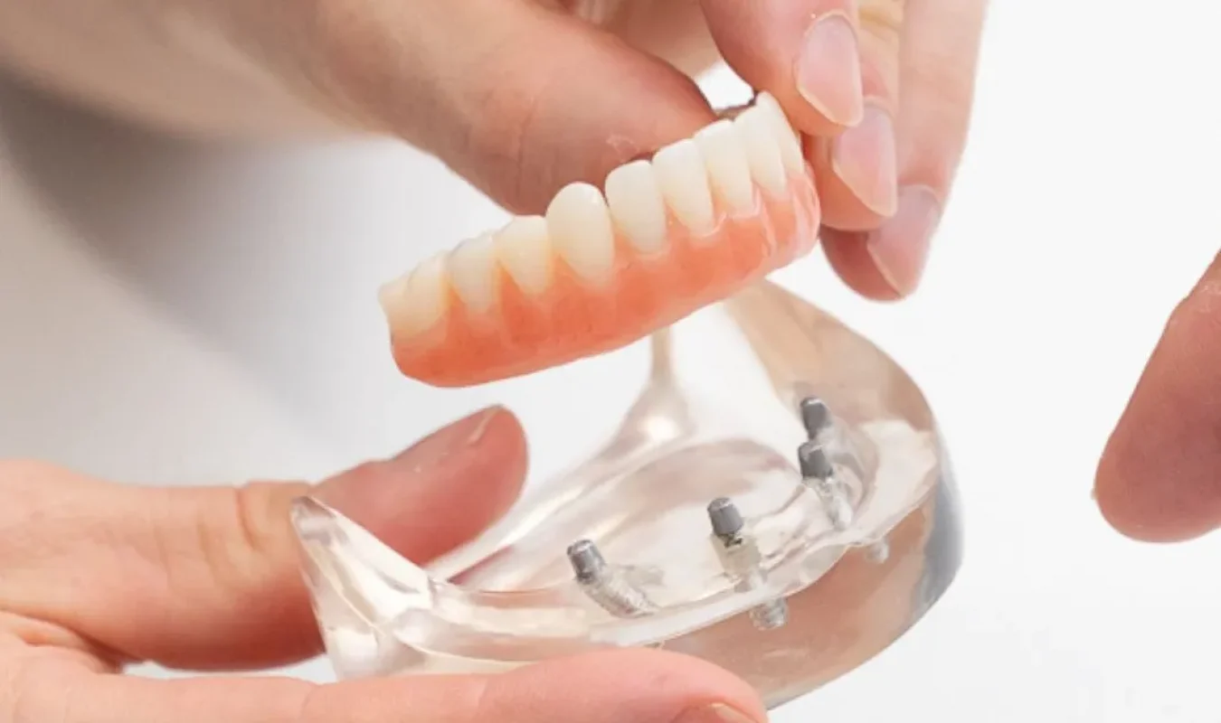 Dental implants at brisbane smiles toowong consult