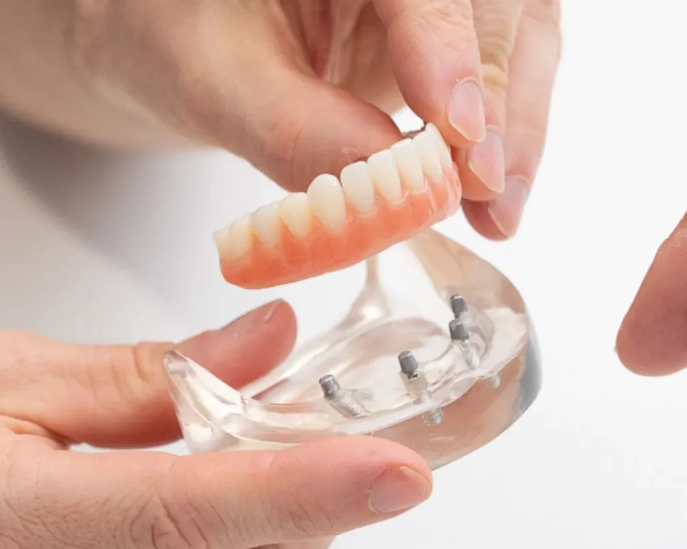 Dental implants at brisbane smiles toowong consult