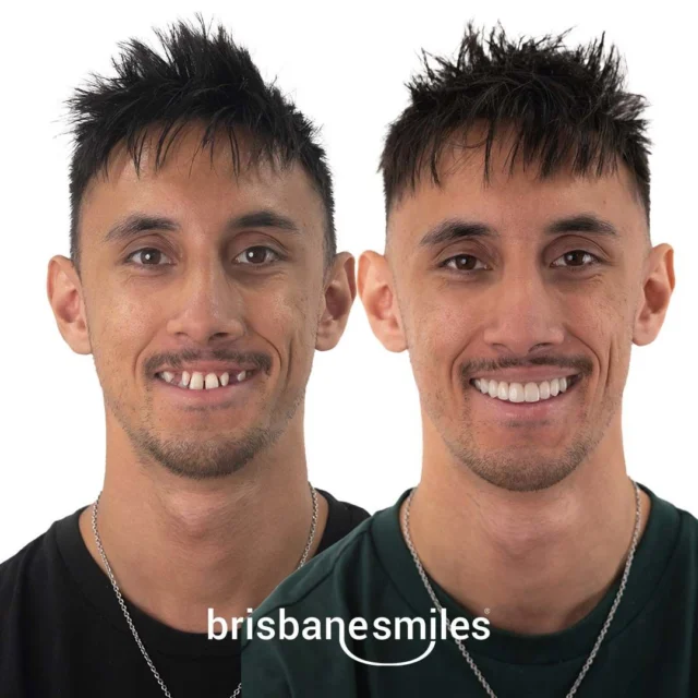 "The first thing I'll do is go home and get a photo with my mum, smiling" 💙 This Smile Makeover has been life-changing for this incredible patient who says he's been waiting years to have the confidence to smile again.

✨ Here at Brisbane Smiles, we truly care about making your smile dreams come true and taking the time to understand what you'd like to achieve with treatment.

Don't put off sharing smiles with loved ones any longer — Book a Smile Makeover Consultation with our expert team today 
🌟 Link in bio.

#smilemakeover #brisbanesmiles #smilesofbrisbane #beforeandafter #porcelaincrowns #dentalmakeover #brisbanedentist #dentalcrowns #dentalbridge #gingivectomy #gumlift

⚠️ Actual patient photo. Individual results will vary. All minor and major dental treatments have risks. Please seek the advice of a qualified healthcare professional before proceeding.
