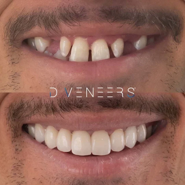 A life-changing smile makeover for this incredible patient 🌟 Our patient said "it has changed my life. I'm not scared to walk into a room and smile, or when meeting someone for the first time I've now got a big smile on my face." 😁

On our unique Smile Design process, this patient said that Brisbane Smiles "treated me as an individual, rather than just another case. It was great to see what my new smile would look like before treatment, so if there was anything that I didn't like, which there wasn't, it gave me an opportunity to visualise it."

For this Smile Makeover, our patient received 3 Dental Bridges, 4 Porcelain Crowns, 6 White Fillings and a Gingivectomy. 

At Brisbane Smiles, we cherish the opportunity to change lives by giving our patients the confidence to smile again 💙 For personalised and transparent Dental Care, look no further than our experienced team ✨ Book a Smile Makeover Consultation today via the link in bio!

#smilemakeover #brisbanesmiles #smilesofbrisbane #beforeandafter #porcelaincrowns #dentalmakeover #brisbanedentist #dentalcrowns #dentalbridge #gingivectomy

⚠️ Actual patient photo. Individual results will vary. All minor and major dental treatments have risks. Please seek the advice of a qualified healthcare professional before proceeding.