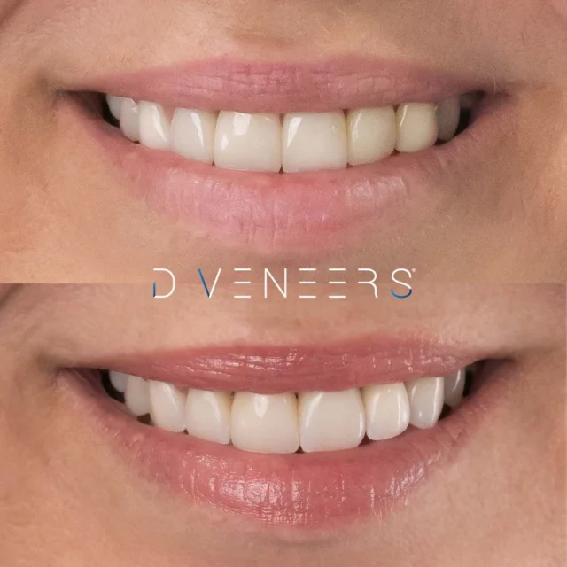 Subtle smile tweaks can make all the difference ✨ For this patient, we refreshed pre-existing Dental Implants and placed Six Porcelain Crowns for optimal aesthetics and functionality. 

If you're considering freshening up past Dental Treatments, book a Consultation with one of our experienced Dentists to find out your best options! Book online via link in bio or call our friendly team on 07 3870 3333 📞

#smilemakeover #brisbanesmiles #smilesofbrisbane #beforeandafter #porcelaincrowns #dentalmakeover #brisbanedentist

⚠️ Actual patient photo. Individual results will vary. All minor and major dental treatments have risks. Please seek the advice of a qualified healthcare professional before proceeding.