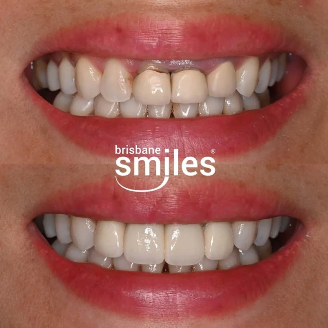 gumlift porcelaincrowns porcelainveneers smilemakeover