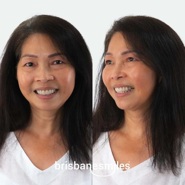 The Smile Makeover After ✨ A naturally radiant result for our wonderful patient!
Our patient had been thinking about closing the gap in her smile for years. Just in time for last Christmas, we achieved this transformation in under a month with 6 x Upper Porcelain Crowns
“Before, I wasn’t smiling with my full teeth… Now, one of my friends said I look so good!”
Her experience at Brisbane Smiles? “It’s more friendly and attentive. Everything is also in the same building, I used to travel for hours between specialists.”
If you have been dreaming of your own Smile Makeover, now is the perfect time. We have extended our Free Smile Makeover Consultations offer until 30 September — book via the link in bio!
#smilemakeover #brisbanesmiles #smilesofbrisbane #beforeandafter #porcelaincrowns #dentalmakeover #brisbanedentist
⚠️ Actual patient photo. Individual results will vary. All minor and major dental treatments have risks. Please seek the advice of a qualified healthcare professional before proceeding.
