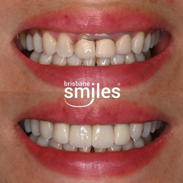 A Smile Makeover for a more balanced, fuller smile 💎 Each Smile Makeover at Brisbane Smiles is specifically tailored to best match your facial features, dental conditions and preferences. This patient received a Gum-lift and 4 x Porcelain Crowns to achieve their dream smile ✨
If you have been dreaming of your own Smile Makeover, now is the perfect time. We have extended our Free Smile Makeover Consultations offer until 30 September — book via the link in bio!
#smilemakeover #brisbanesmiles #smilesofbrisbane #beforeandafter #porcelaincrowns #dentalmakeover #brisbanedentist
⚠️ Actual patient photo. Individual results will vary. All minor and major dental treatments have risks. Please seek the advice of a qualified healthcare professional before proceeding.