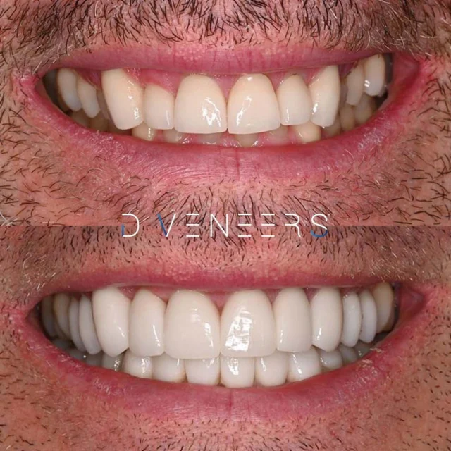 gumlift porcelainveneers porcelaincrowns dveneers smilemakeover