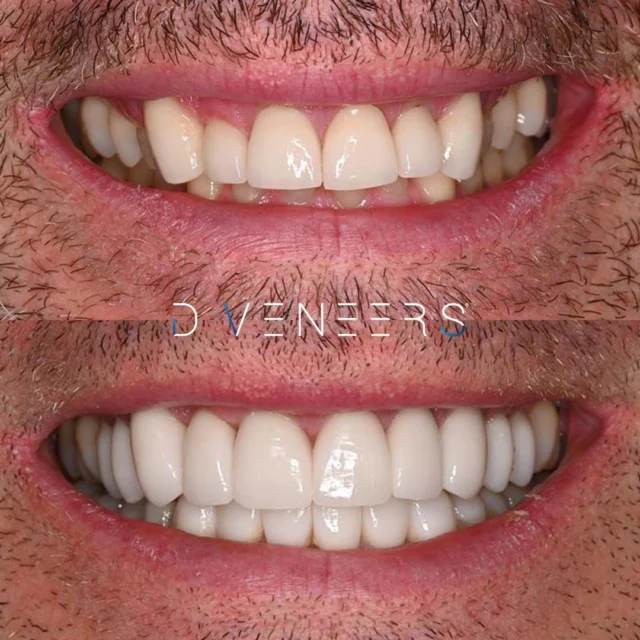 A Smile Makeover Treatment to assist with smile alignment, discolouration and function 🌟 This wonderful patient received a customised Smile Makeover with 10 Upper and 6 Lower Porcelain Crowns, and a Gum-Lift.
Each Porcelain Crown at Brisbane Smiles is hand-crafted in our onsite Dental Laboratory for optimal artistry, quality and customisation 💎. In this case, a Gum-Lift was also used to treat excessive gum tissue. The result is a fuller, brighter smile!
If you are interested in finding out your best Smile Makeover treatment options, we are offering FREE Smile Makeover Consults, only until 30 September! Limited spots are available, book via the link in our bio 🔗
⚠️ Actual patient photo. Individual results will vary. All minor and major dental treatments have risks. Please seek the advice of a qualified healthcare professional before proceeding.
#smilemakeover #porcelaincrowns #beforeandafter #veneersbeforeafter #porcelainveneers #gumlift