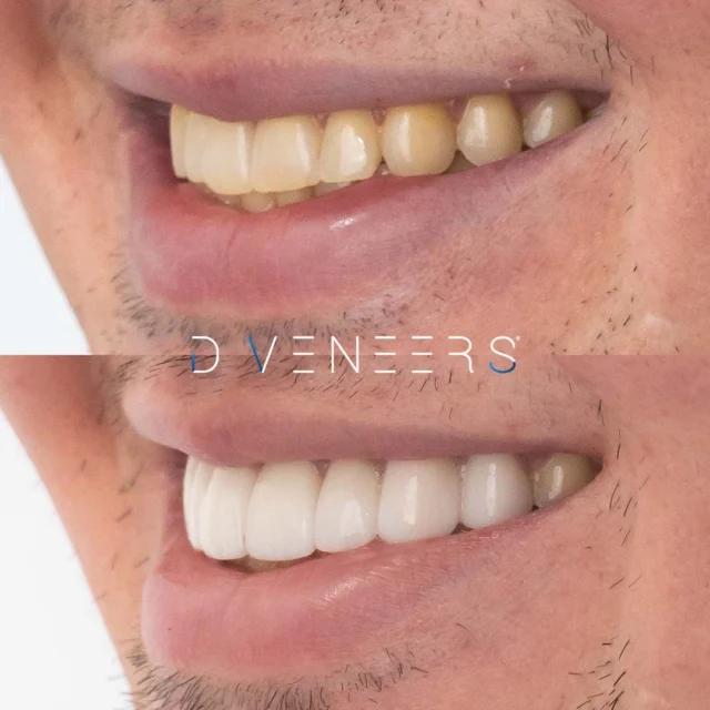 We customised this patient’s Smile Makeover with 8 Upper Anterior DVeneers and Zoom Teeth Whitening, to treat tooth discolouration 🦷
have
If you have been considering a Smile Makeover, look no further than the experts at Brisbane Smiles for bespoke and top-quality treatment. To find out your best treatment options, we are offering FREE Smile Makeover Consults only until September 30th. Limited spots left - book online today!
#smilemakeover #brisbanesmiles #smilesofbrisbane #beforeandafter #porcelaincrowns #dentalmakeover #brisbanedentist
⚠️ Actual patient photo. Individual results will vary. All minor and major dental treatments have risks. Please seek the advice of a qualified healthcare professional before proceeding.