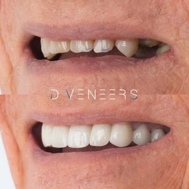 This patient’s Smile Makeover included 13 Upper Porcelain Crowns and a 4-Unit Lower Dental Bridge, carefully designed to restore harmony, function and aesthetics.
Every detail of this transformation was tailored to suit the patient’s unique features and preferences.
Considering a Smile Makeover? Our expert team is here to guide you through every step. Book a FREE Consultation via the link in bio today 🌟 Complimentary Consultations only valid until September 30!
#smilemakeover #brisbanesmiles #beforeandafter #smiletransformation #porcelaincrowns #dentalbridge #brisbanedentist #naturalsmile
⚠️ Actual patient photo showing the outcome of treatment at Brisbane Smiles, photo shared with consent. Individual results vary and depend on dental conditions. Images have not been edited or altered. Outcomes shown do not guarantee the same result for every patient. Please seek the advice of a qualified healthcare professional before proceeding. All minor and major dental treatments have risks, visit our website for more information www.bsmiles.online