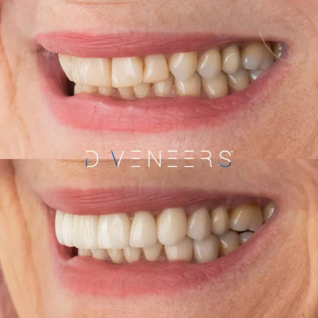 Smile Makeover with a bespoke treatment plan to address our patient's pre-existing chipped and stained Resin Veneers and mask tooth crowding without using Orthodontics ✨ Treatment included 8 upper and 8 lower Porcelain Veneers made in our in-house Dental Laboratory.

Book your consultation today via the link in our bio!

#smilemakeover #brisbanesmiles #smilesofbrisbane #beforeandafter #porcelaincrowns #dentalmakeover #brisbanedentist

⚠️Treatment outcomes differ for each individual and cannot be guaranteed. All photos and videos feature actual patients and are for informational purposes only. All surgical or invasive procedures carry risks. Before proceeding, consult a qualified health practitioner and seek a second opinion. Go to bsmiles.au/txinfo to learn about potential risks and important treatment considerations.