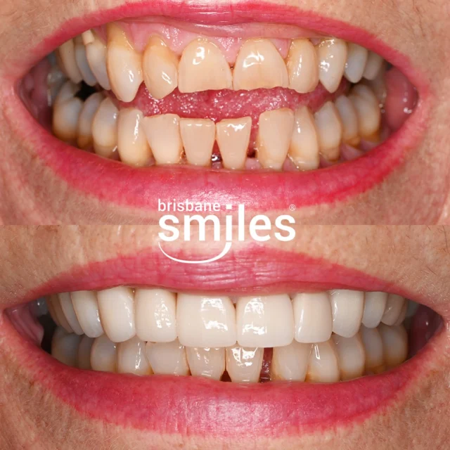 A Complete Smile Transformation with Porcelain Crowns ✨ This patient received 10 Upper Porcelain Crowns, expertly crafted to restore broken and discoloured teeth. 🦷

Porcelain Crowns may be an excellent option for repairing broken, weakened or damaged teeth while maintaining a natural and aesthetically pleasing look.

At Brisbane Smiles, we offer Porcelain Crowns that are customised to suit your needs! Book your complimentary consultation by visiting the link in our bio or by calling us on 3870 3333.

*View full T&Cs on our website, link in bio. Offer valid until 31 March 2026.

#brisbanesmiles #brisbanedentist #bestbrisbanedentist #porcelaincrowns

Provider: Dr Graham McKay 
General Dentist (DEN0001346655) 

⚠️ Treatment outcomes differ for each individual and cannot be guaranteed. All photos and videos feature actual patients and are for informational purposes only. All surgical or invasive procedures carry risks. Before proceeding, consult a qualified health practitioner and seek a second opinion. Go to bsmiles.au/txinfo to learn about potential risks and important treatment considerations.