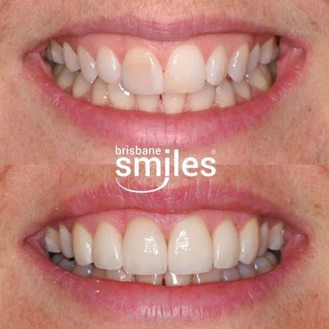 Smilemakeover gumlift veneers dveneers porcelainveneers ⚠️Treatment outcomes differ for each individual and cannot be guaranteed. All photos and videos feature actual patients and are for informational purposes only. All surgical or invasive procedures carry risks. Before proceeding, consult a qualified health practitioner and seek a second opinion. Go to bsmiles.au/txinfo to learn about potential risks and important treatment considerations.