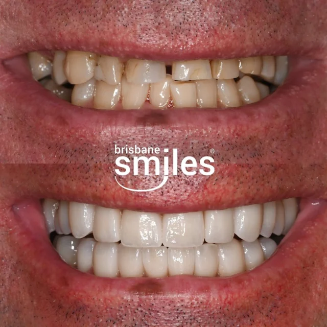 Smilemakeover porcelaincrowns veneers dveneers gumlift ⚠️Treatment outcomes differ for each individual and cannot be guaranteed. All photos and videos feature actual patients and are for informational purposes only. All surgical or invasive procedures carry risks. Before proceeding, consult a qualified health practitioner and seek a second opinion. Go to bsmiles.au/txinfo to learn about potential risks and important treatment considerations.