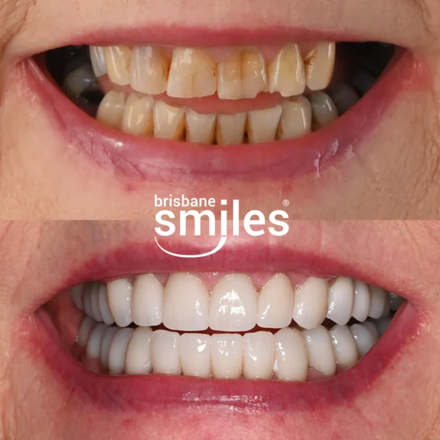 Smile Makeover! 🌟🦷 For this patient, we completed a bespoke treatment plan to address worn, chipped, and weakened teeth. This comprehensive full-mouth restoration included 28 Porcelain Crowns and 2 Dental Implants, all carefully planned and custom-crafted in our in-house Dental Laboratory to restore both function and aesthetics.

At Brisbane Smiles, we ensure every treatment is tailored to your unique preferences and conditions. Book your complimentary consultation by visiting the link in our bio or by calling us on 3870 3333. 

Provider: Andrei Mihailescu 
General Dentist (DEN0002177882)

#BrisbaneSmiles #SmileMakeover #porcelaincrowns 

⚠️ Treatment outcomes differ for each individual and cannot be guaranteed. All photos and videos feature actual patients and are for informational purposes only. All surgical or invasive procedures carry risks. Before proceeding, consult a qualified health practitioner and seek a second opinion. Go to bsmiles.au/txinfo to learn about potential risks and important treatment considerations.