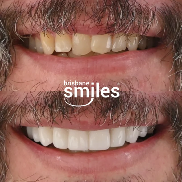 Smile Makeover! 🌟🦷
For this patient, we created a custom treatment plan to restore and enhance their upper teeth. The result? 10 bespoke Porcelain Crowns, carefully crafted to improve both function and aesthetics.

These upper crowns were designed to provide a natural, balanced, and long-lasting smile. Each crown was custom-made in our in-house dental laboratory for precision and quality.

Book your complimentary consultation by visiting the link in our bio or by calling us on 3870 3333. 📲

Provider: Andrei Mihailescu 
General Dentist (DEN0002177882)

#BrisbaneSmiles #SmileMakeover #porcelaincrowns 

⚠️ Treatment outcomes differ for each individual and cannot be guaranteed. All photos and videos feature actual patients and are for informational purposes only. All surgical or invasive procedures carry risks. Before proceeding, consult a qualified health practitioner and seek a second opinion. Go to bsmiles.au/txinfo to learn about potential risks and important treatment considerations.