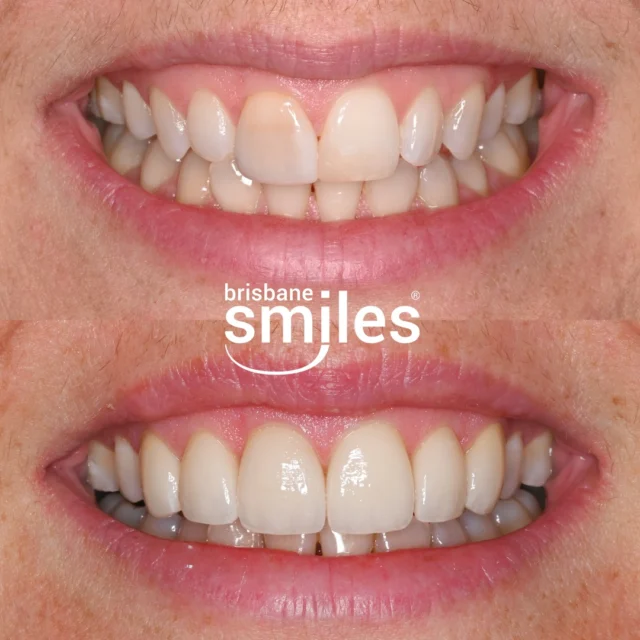 Smile Makeover 🌟This patient’s Smile Makeover included a Gum Lift and 6 Upper Porcelain Veneers, creating a brighter, more balanced-looking smile. 

Porcelain Veneers are ultra-thin, custom-crafted layers that are bonded to your teeth to create a long-lasting, natural-looking smile. Made in our in-house Dental Laboratory, each veneer is carefully designed with precision and expert craftsmanship to complement your unique smile. 

Every Smile Makeover is tailored to your individual needs, combining advanced techniques and personalised treatment planning to achieve long-lasting results.

We are currently offering Complimentary Consultations for Smile Makeovers, Veneers, Dental Implants, TeethXpress, Invisalign & Second Opinions. 

Book your complimentary consultation today by visiting the link in our bio, or by calling 3870 3333. 📲

*View full T&Cs on our website. Offer valid until 31 March 2026.

Provider: Dr Tara Møller
General Dentist (DEN0002136859) 

#brisbanesmiles #brisbanedentist #generaldentist

⚠️ Treatment outcomes differ for each individual and cannot be guaranteed. All photos and videos feature actual patients and are for informational purposes only. All surgical or invasive procedures carry risks. Before proceeding, consult a qualified health practitioner and seek a second opinion. Go to bsmiles.au/txinfo to learn about potential risks and important treatment considerations.