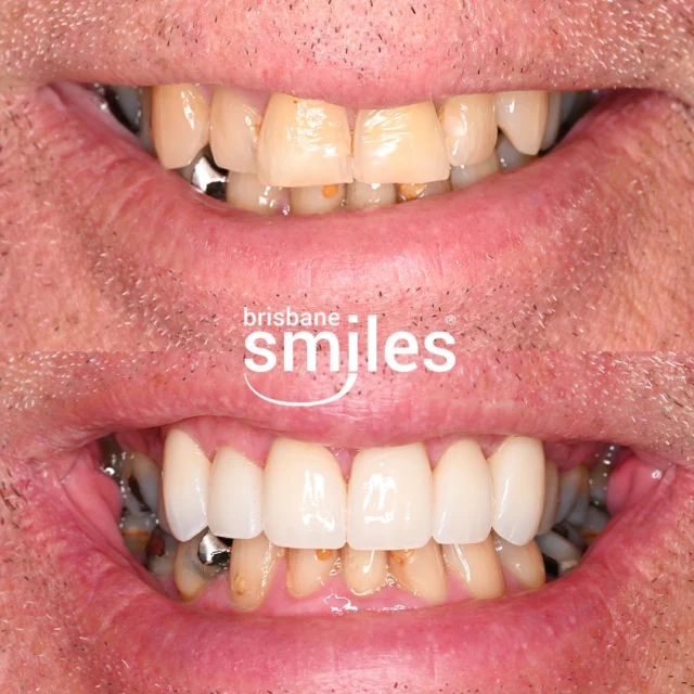 Smile Makeover 🌟 We transformed this patient’s smile with 6 Upper Zirconia Crowns, custom-crafted in our in-house Dental Laboratory. The crowns enhanced the colour, shape and symmetry of the teeth, giving a natural and more balanced smile. 😁

Are you looking to restore the appearance and functionality of your teeth? Zirconia Crowns are an excellent option for repairing broken, weakened or discoloured teeth while maintaining a natural and aesthetically pleasing look. Each crown is customised to suit your individual needs.

We are currently offering Complimentary Consultations for Smile Makeovers, Veneers, Dental Implants, TeethXpress, Invisalign and Second Opinions.

Book your complimentary consultation by visiting the link in our bio  or by calling us on 3870 3333.
 
*View full T&Cs on our website, link in bio. Offer valid until 31 March 2026.

Provider: Dr Paul McKay 
General Dentist (DEN0000958298) 

#smilemakeover #brisbanesmiles #brisbanedentist 

⚠️ Treatment outcomes differ for each individual and cannot be guaranteed. All photos and videos feature actual patients and are for informational purposes only. All surgical or invasive procedures carry risks. Before proceeding, consult a qualified health practitioner and seek a second opinion. Go to bsmiles.au/txinfo to learn about potential risks and important treatment considerations.