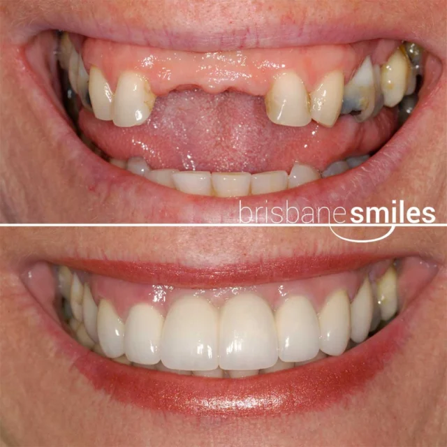 missingteeth porcelainbridge #brisbanesmiles ⚠️Treatment outcomes differ for each individual and cannot be guaranteed. All photos and videos feature actual patients and are for informational purposes only. All surgical or invasive procedures carry risks. Before proceeding, consult a qualified health practitioner and seek a second opinion. Go to bsmiles.au/txinfo to learn about potential risks and important treatment considerations.