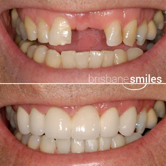 missingteeth porcelainbridge #brisbanesmiles ⚠️Treatment outcomes differ for each individual and cannot be guaranteed. All photos and videos feature actual patients and are for informational purposes only. All surgical or invasive procedures carry risks. Before proceeding, consult a qualified health practitioner and seek a second opinion. Go to bsmiles.au/txinfo to learn about potential risks and important treatment considerations.