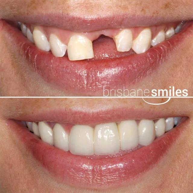 missingteeth porcelainbridge #brisbanesmiles ⚠️Treatment outcomes differ for each individual and cannot be guaranteed. All photos and videos feature actual patients and are for informational purposes only. All surgical or invasive procedures carry risks. Before proceeding, consult a qualified health practitioner and seek a second opinion. Go to bsmiles.au/txinfo to learn about potential risks and important treatment considerations.