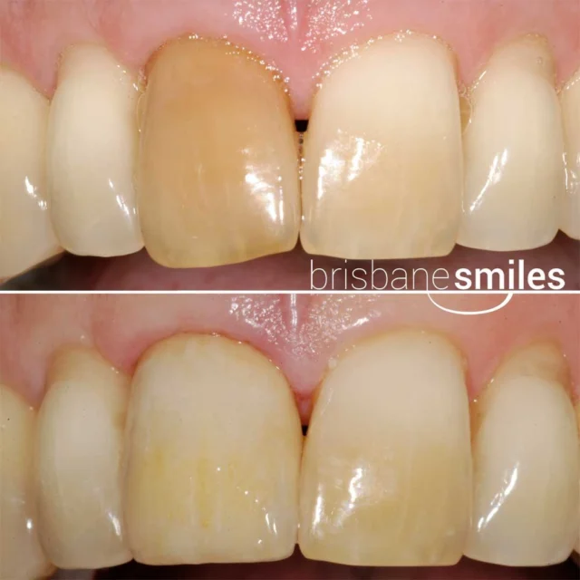 discolouredteeth porcelaincrown #brisbanesmiles ⚠️Treatment outcomes differ for each individual and cannot be guaranteed. All photos and videos feature actual patients and are for informational purposes only. All surgical or invasive procedures carry risks. Before proceeding, consult a qualified health practitioner and seek a second opinion. Go to bsmiles.au/txinfo to learn about potential risks and important treatment considerations.