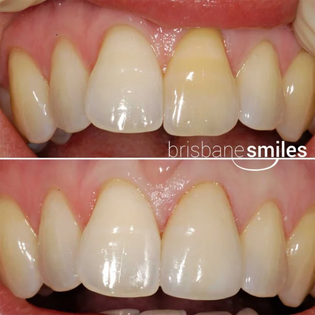 discolouredteeth singlefronttooth yellowteeth emaxveneer #brisbanesmiles ⚠️Treatment outcomes differ for each individual and cannot be guaranteed. All photos and videos feature actual patients and are for informational purposes only. All surgical or invasive procedures carry risks. Before proceeding, consult a qualified health practitioner and seek a second opinion. Go to bsmiles.au/txinfo to learn about potential risks and important treatment considerations.
