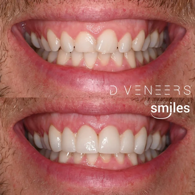 wornteeth 6porcelainveneers dveneers #brisbanesmiles ⚠️Treatment outcomes differ for each individual and cannot be guaranteed. All photos and videos feature actual patients and are for informational purposes only. All surgical or invasive procedures carry risks. Before proceeding, consult a qualified health practitioner and seek a second opinion. Go to bsmiles.au/txinfo to learn about potential risks and important treatment considerations.