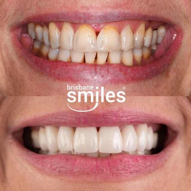 Smile Makeover 🎉This patient’s smile transformation included 8 Upper Porcelain Crowns, a Gum Lift on 3 teeth, and In-Chair Whitening, creating a brighter, fuller, and more balanced-looking smile. This smile was carefully crafted to enhance both function and aesthetics.

Porcelain Crowns are custom-crafted to restore the appearance and strength of teeth that are worn, discoloured, or damaged. Made in our in-house Dental Laboratory, each Crown is designed with precision to suit your unique smile.

We are currently offering Complimentary Consultations for Smile Makeovers, Veneers, Dental Implants, TeethXpress, Invisalign and Second Opinions.

Book your complimentary consultation by visiting the link in our bio, or by calling us on 3870 3333. 📲 

*View full T&Cs on our website, link in bio. Offer valid until 31 March 2026.

Provider: Dr Graham McKay
General Dentist (DEN0001346655)

#smilemakeover #brisbanesmiles #PorcelainCrownsBrisbane

⚠️ Treatment outcomes differ for each individual and cannot be guaranteed. All photos and videos feature actual patients and are for informational purposes only. All surgical or invasive procedures carry risks. Before proceeding, consult a qualified health practitioner and seek a second opinion. Go to bsmiles.au/txinfo to learn about potential risks and important treatment considerations.