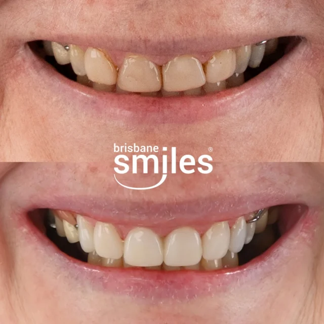 Smile Makeover 💫 This patient’s smile transformation included 6 Resin Veneers, creating a brighter, more balanced-looking smile. 

At Brisbane Smiles, we offer both Porcelain and Resin Veneers, allowing us to tailor your treatment to your goals, lifestyle, and budget. While Resin Veneers are generally a shorter-term option compared to Porcelain, with expert design, technique, and proper care, they can last 5+ years, providing a natural-looking smile.

Until the end of March only, we are offering Complimentary Consultations for Smile Makeovers, Veneers, Dental Implants, TeethXpress, Invisalign and Second Opinions.

Book your complimentary consultation by visiting the link in our bio, or by calling us on 3870 3333.

*View full T&Cs on our website, link in bio. Offer valid until 31 March 2026.

Provider: Andrei Mihailescu 
General Dentist (DEN0002177882)

#brisbanesmiles #smiletransformation #brisbanedentist

⚠️ Treatment outcomes differ for each individual and cannot be guaranteed. All photos and videos feature actual patients and are for informational purposes only. All surgical or invasive procedures carry risks. Before proceeding, consult a qualified health practitioner and seek a second opinion. Go to bsmiles.au/txinfo to learn about potential risks and important treatment considerations.
