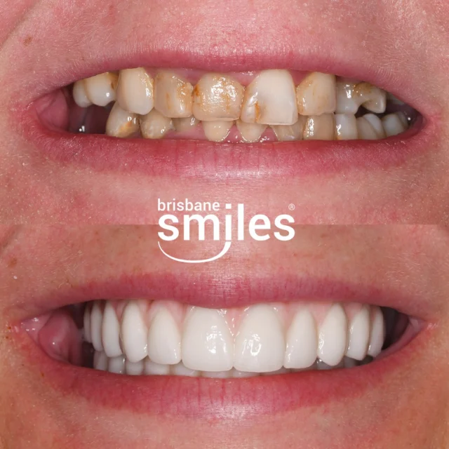 TeethXpress Transformation 💙 This patient received TeethXpress Full Upper and Lower Titanium-Zirconia Bridges, delivering a complete smile restoration with strength and stability.

Designed for patients requiring a full jaw of teeth replacements, TeethXpress offers a fixed, long-term solution that restores function and a full jaw of new teeth — all carefully tailored to the individual.

Provider: Dr Paul McKay
General Dentist (DEN0000958298)

Book a Complimentary TeethXpress Consultation today and find out how we can restore your smile! Book your complimentary consultation by visiting the link in our bio, or by calling us on 3870 3333. *View full T&Cs on our website, link in bio. Offer valid until 31 March 2026.

#Brisbanesmiles #brisbanedentist #smilemakeover #teethxpress #dentalimplants #newsmile

⚠️ Treatment outcomes differ for each individual and cannot be guaranteed. All photos and videos feature actual patients and are for informational purposes only. All surgical or invasive procedures carry risks. Before proceeding, consult a qualified health practitioner and seek a second opinion. Go to bsmiles.au/txinfo to learn about potential risks and important treatment considerations.