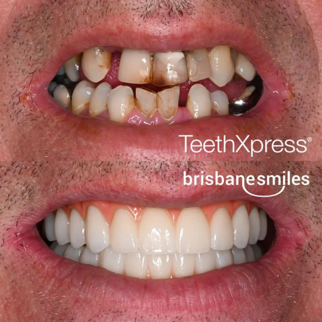 teethxpress dentalimplants implants implant dentalimplant smilemakeover dentalmakeover ⚠️Treatment outcomes differ for each individual and cannot be guaranteed. All photos and videos feature actual patients and are for informational purposes only. All surgical or invasive procedures carry risks. Before proceeding, consult a qualified health practitioner and seek a second opinion. Go to bsmiles.au/txinfo to learn about potential risks and important treatment considerations.