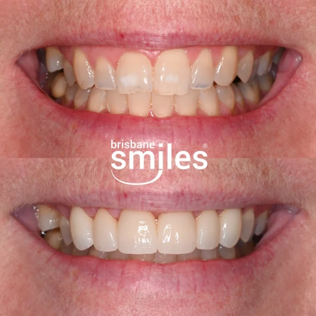 Smile Makeover with hand-crafted Porcelain Crowns ✨

This Smile Makeover included 6 Upper Anterior Zirconia Crowns, restoring balance, symmetry, and confidence.

Each Crown was custom-crafted in our onsite Dental Laboratory to suit the patient’s facial features and natural tooth structure, ensuring a seamless and refined result.

Provider: Dr Paul McKay
General Dentist (DEN0000958298)

Book a Dental Makeover Consultation today and find out how we can transform your smile! 

#Brisbanesmiles #brisbanedentist #smilemakeover 

⚠️ Treatment outcomes differ for each individual and cannot be guaranteed. All photos and videos feature actual patients and are for informational purposes only. All surgical or invasive procedures carry risks. Before proceeding, consult a qualified health practitioner and seek a second opinion. Go to bsmiles.au/txinfo to learn about potential risks and important treatment considerations.