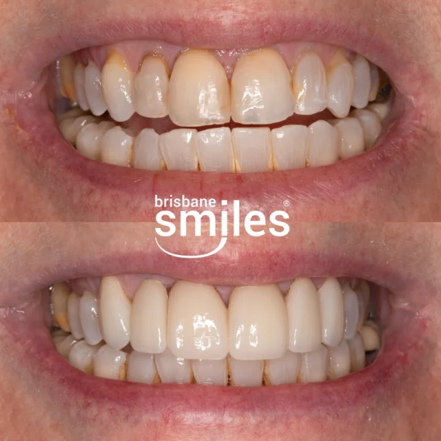 Smile Restoration with Porcelain Crowns 🌟 This patient’s transformation involved 6 Upper Anterior Zirconia Porcelain Crowns, carefully designed to enhance strength, colour, and symmetry.

Zirconia Crowns offer a durable and aesthetic solution for restoring front teeth, delivering a natural-looking smile that’s built to last.

Provider: Dr Paul McKay
General Dentist (DEN0000958298)

Book a Dental Makeover Consultation today and find out how we can transform your smile! 

#Brisbanesmiles #brisbanedentist #smilemakeover 

⚠️ Treatment outcomes differ for each individual and cannot be guaranteed. All photos and videos feature actual patients and are for informational purposes only. All surgical or invasive procedures carry risks. Before proceeding, consult a qualified health practitioner and seek a second opinion. Go to bsmiles.au/txinfo to learn about potential risks and important treatment considerations.
