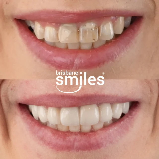 Smile Makeover 💫 This patient’s transformation included 10 Upper Porcelain Crowns, with the bite carefully adjusted to improve facial proportions.

The Porcelain Crowns were custom-crafted in our in-house Dental Laboratory to enhance colour, shape, and symmetry, while restoring strength and function. By opening the bite, we not only improved the patient’s smile but also balanced facial aesthetics, giving a more harmonious and natural look.

Every Smile Makeover at Brisbane Smiles is tailored to the individual, combining advanced techniques and personalised planning. 

To explore your options, book a Consultation by visiting the link in our bio or by calling our friendly team on 3870 3333. 💙

#brisbanesmiles #brisbanedentist #smilemakeover

⚠️ Treatment outcomes differ for each individual and cannot be guaranteed. All photos and videos feature actual patients and are for informational purposes only. All surgical or invasive procedures carry risks. Before proceeding, consult a qualified health practitioner and seek a second opinion. Go to bsmiles.au/txinfo to learn about potential risks and important treatment considerations.