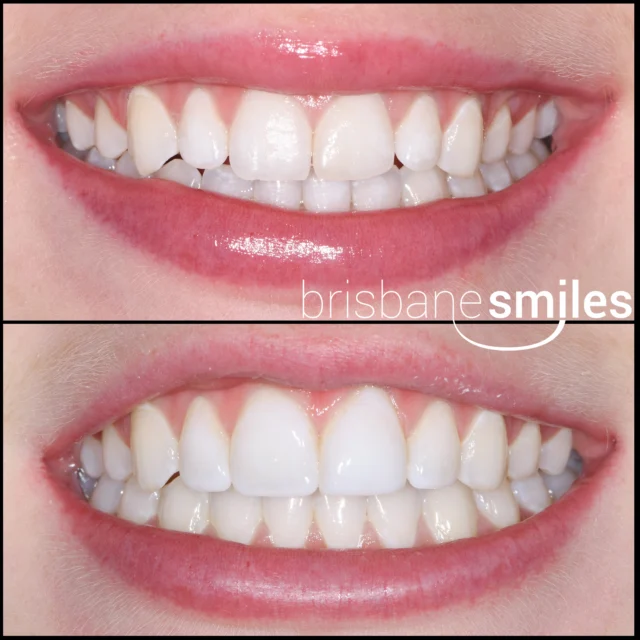 resinveneers bonding 6teeth uneventeeth smallteeth #brisbanesmiles ⚠️Treatment outcomes differ for each individual and cannot be guaranteed. All photos and videos feature actual patients and are for informational purposes only. All surgical or invasive procedures carry risks. Before proceeding, consult a qualified health practitioner and seek a second opinion. Go to bsmiles.au/txinfo to learn about potential risks and important treatment considerations.
Edited · 31w
