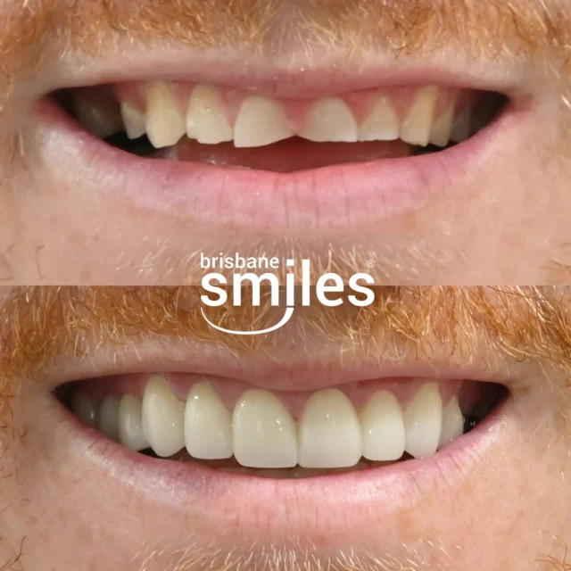 Smile Makeover 🌟 This patient’s journey began with pre-restorative Invisalign treatment, followed by 7 Upper Porcelain Crowns and 1 Upper Porcelain Dental Bridge.

Aligning the teeth first allowed for conservative preparation and optimal positioning, while the Crowns and Bridge restored strength, aesthetics, and balance — delivering a seamless and functional smile transformation.

Book a Dental Makeover Consultation today and see how we can transform your smile!

#Brisbanesmiles #brisbanedentist #smilemakeover 

⚠️ Treatment outcomes differ for each individual and cannot be guaranteed. All photos and videos feature actual patients and are for informational purposes only. All surgical or invasive procedures carry risks. Before proceeding, consult a qualified health practitioner and seek a second opinion. Go to bsmiles.au/txinfo to learn about potential risks and important treatment considerations.