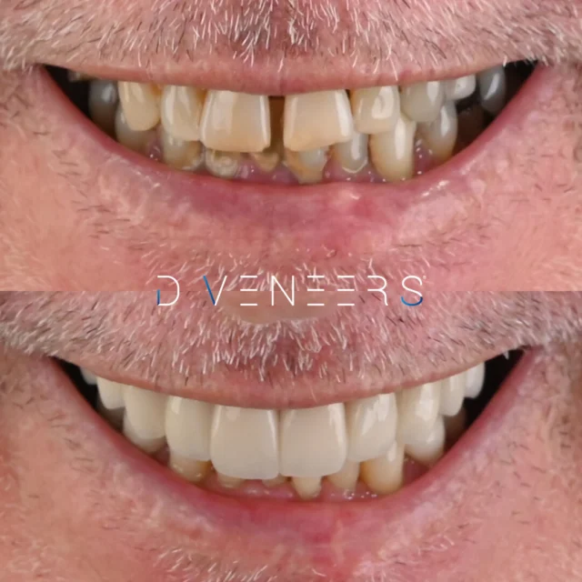 Smile Makeover ✨This patient’s smile was completely transformed with 10 upper and 4 lower Porcelain Crowns, custom-crafted in our onsite Brisbane Smiles Dental Laboratory. The Porcelian Crowns enhanced the colour, shape, and symmetry of the teeth, giving a more natural and balanced smile 😁.

Porcelain Crowns are a durable and aesthetic solution for restoring broken, weakened, or discoloured teeth. Each Crown is carefully customised to suit the patient’s individual needs, ensuring a seamless and natural result.

At Brisbane Smiles, we ensure every treatment is tailored to your unique goals. Book your consultation by visiting the link in our bio,  or by calling us on 3870 3333. 

Provider: Andrei Mihailescu 
General Dentist (DEN0002177882)

⚠️ Treatment outcomes differ for each individual and cannot be guaranteed. All photos and videos feature actual patients and are for informational purposes only. All surgical or invasive procedures carry risks. Before proceeding, consult a qualified health practitioner and seek a second opinion. Go to bsmiles.au/txinfo to learn about potential risks and important treatment considerations.