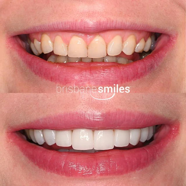 Smilemakeover gumlift crowns crowdedteeth uneventeeth dentalimplants veneersfeature ⚠️Treatment outcomes differ for each individual and cannot be guaranteed. All photos and videos feature actual patients and are for informational purposes only. All surgical or invasive procedures carry risks. Before proceeding, consult a qualified health practitioner and seek a second opinion. Go to bsmiles.au/txinfo to learn about potential risks and important treatment considerations.