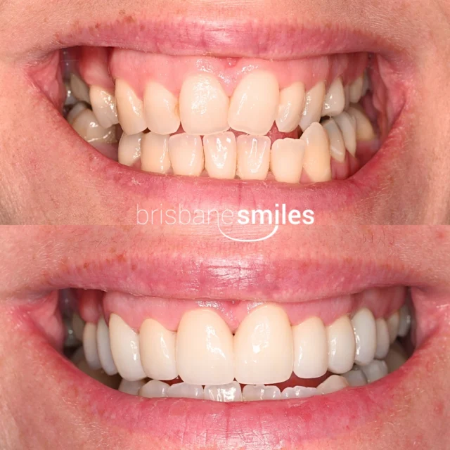 Smilemakeover porcelaincrowns crowdedteeth uneventeeth ⚠️Treatment outcomes differ for each individual and cannot be guaranteed. All photos and videos feature actual patients and are for informational purposes only. All surgical or invasive procedures carry risks. Before proceeding, consult a qualified health practitioner and seek a second opinion. Go to bsmiles.au/txinfo to learn about potential risks and important treatment considerations.
