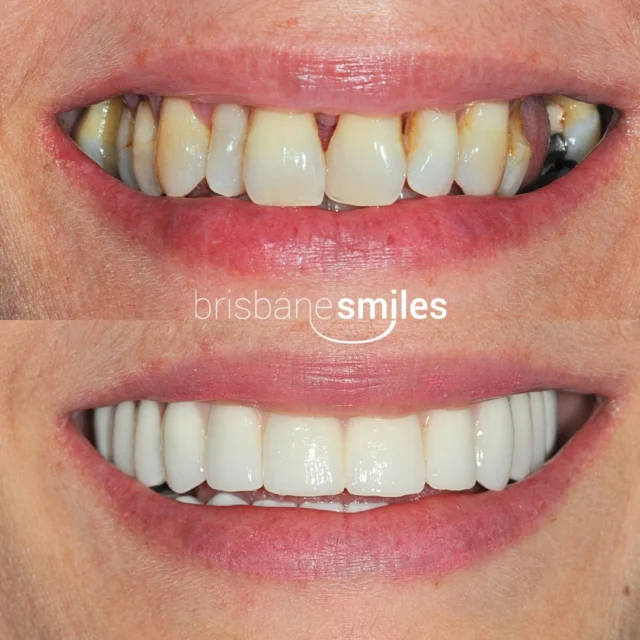 teethxpress dentalimplants implants implant dentalimplant smilemakeover dentalmakeover gumdisease missingteeth⚠️Treatment outcomes differ for each individual and cannot be guaranteed. All photos and videos feature actual patients and are for informational purposes only. All surgical or invasive procedures carry risks. Before proceeding, consult a qualified health practitioner and seek a second opinion. Go to bsmiles.au/txinfo to learn about potential risks and important treatment considerations.