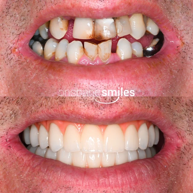 teethxpress dentalimplants implants implant dentalimplant smilemakeover dentalmakeover decayedteeth missingteeth⚠️Treatment outcomes differ for each individual and cannot be guaranteed. All photos and videos feature actual patients and are for informational purposes only. All surgical or invasive procedures carry risks. Before proceeding, consult a qualified health practitioner and seek a second opinion. Go to bsmiles.au/txinfo to learn about potential risks and important treatment considerations.