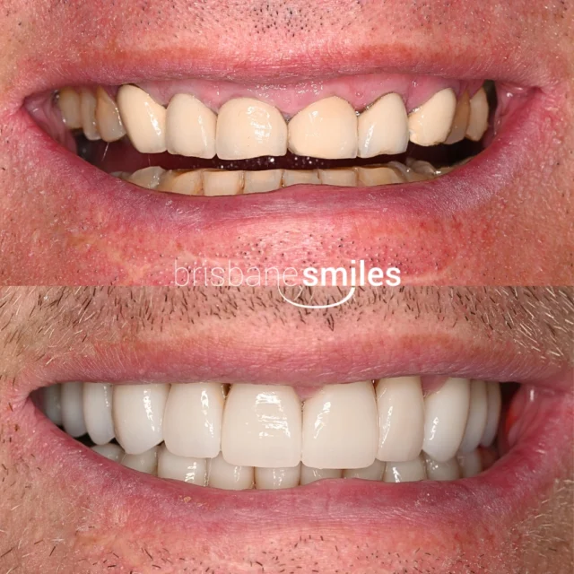 Smilemakeover porcelaincrowns gumlift olddentistry wornteeth yellowteeth⚠️Treatment outcomes differ for each individual and cannot be guaranteed. All photos and videos feature actual patients and are for informational purposes only. All surgical or invasive procedures carry risks. Before proceeding, consult a qualified health practitioner and seek a second opinion. Go to bsmiles.au/txinfo to learn about potential risks and important treatment considerations.
