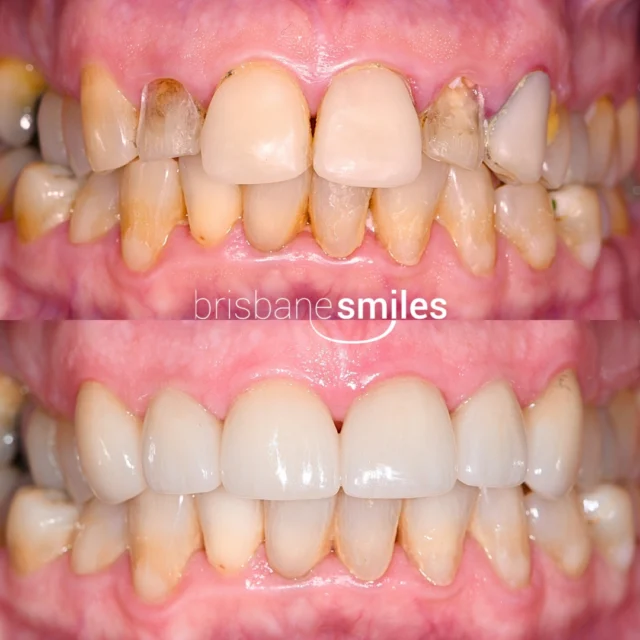 Smilemakeover porcelaincrowns olddentistry uneventeeth ⚠️Treatment outcomes differ for each individual and cannot be guaranteed. All photos and videos feature actual patients and are for informational purposes only. All surgical or invasive procedures carry risks. Before proceeding, consult a qualified health practitioner and seek a second opinion. Go to bsmiles.au/txinfo to learn about potential risks and important treatment considerations.