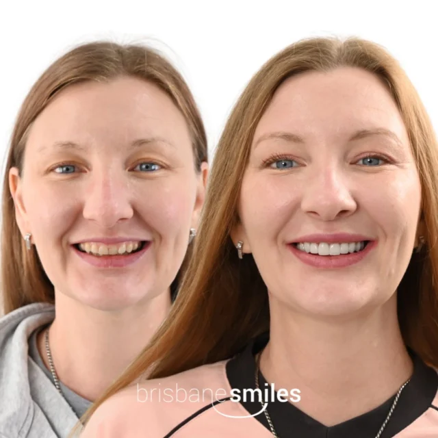 Smilemakeover gumlift crowns uneventeeth dentalimplants crowdedteeth veneersfeature ⚠️Treatment outcomes differ for each individual and cannot be guaranteed. All photos and videos feature actual patients and are for informational purposes only. All surgical or invasive procedures carry risks. Before proceeding, consult a qualified health practitioner and seek a second opinion. Go to bsmiles.au/txinfo to learn about potential risks and important treatment considerations.