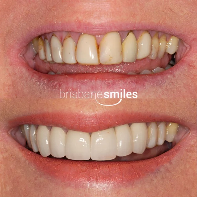 Smilemakeover crowns olddentistry oldresinbonding uneventeeth yellowteeth staining⚠️Treatment outcomes differ for each individual and cannot be guaranteed. All photos and videos feature actual patients and are for informational purposes only. All surgical or invasive procedures carry risks. Before proceeding, consult a qualified health practitioner and seek a second opinion. Go to bsmiles.au/txinfo to learn about potential risks and important treatment considerations.