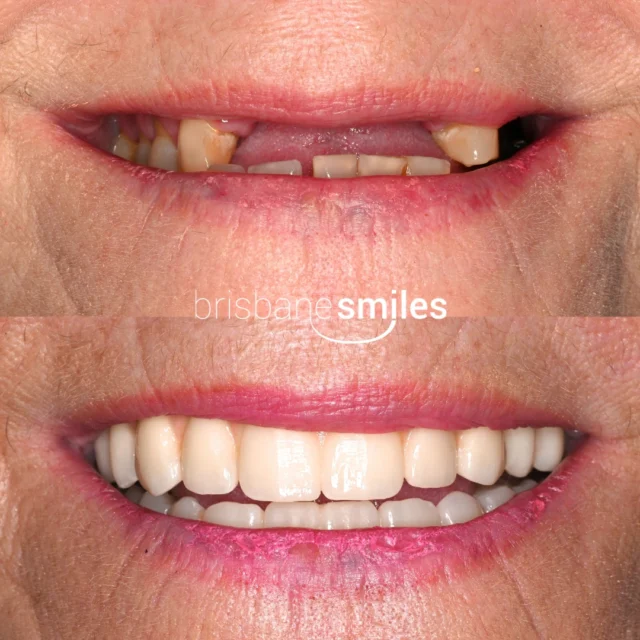 teethxpress dentalimplants implants implant dentalimplant smilemakeover dentalmakeover missingteeth⚠️Treatment outcomes differ for each individual and cannot be guaranteed. All photos and videos feature actual patients and are for informational purposes only. All surgical or invasive procedures carry risks. Before proceeding, consult a qualified health practitioner and seek a second opinion. Go to bsmiles.au/txinfo to learn about potential risks and important treatment considerations.
